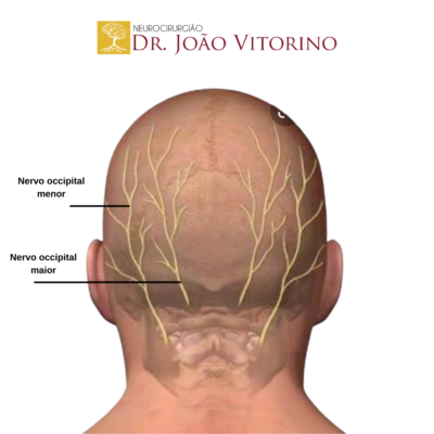 Neuralgia occipital Neurocirurgião em São Paulo Especialista em