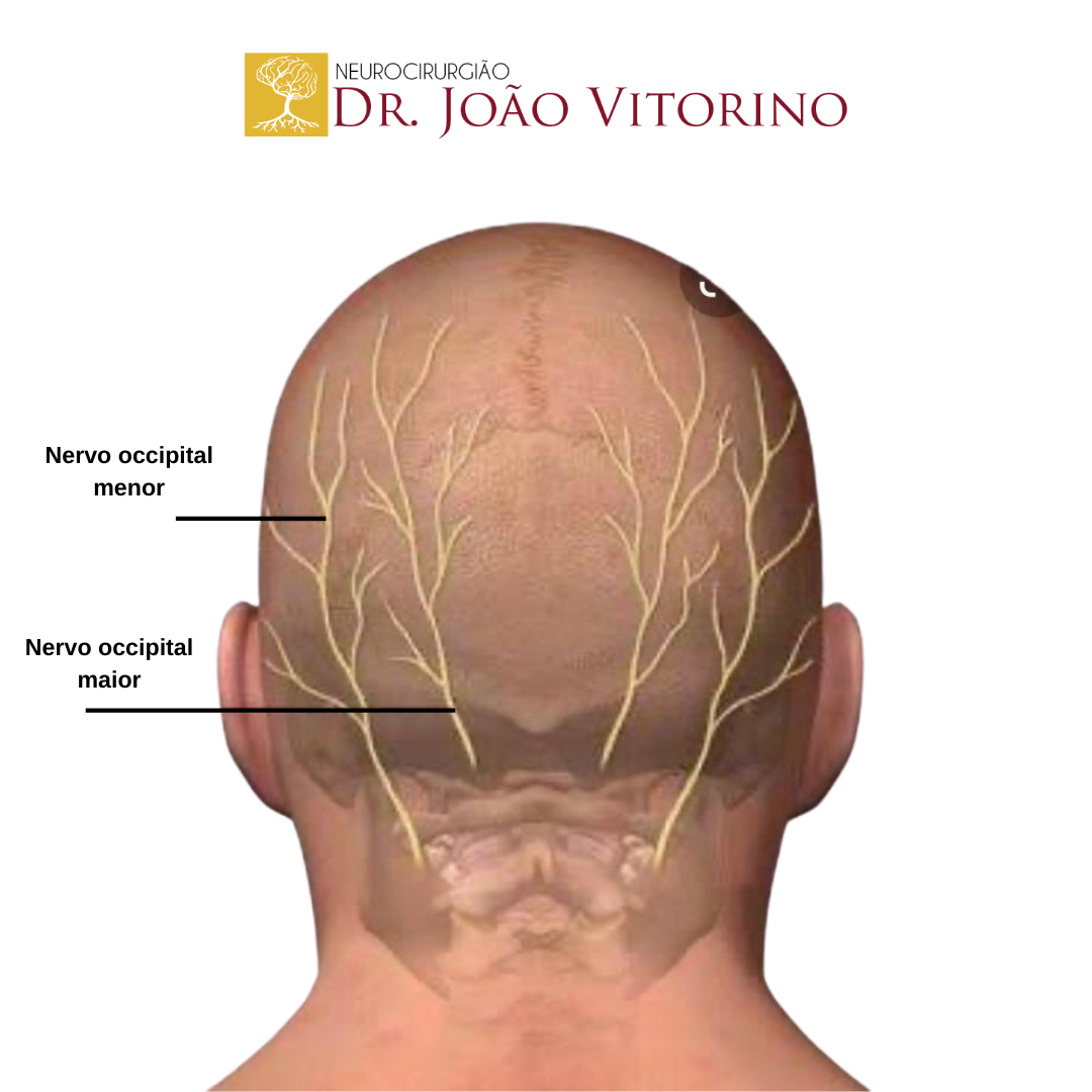 Neuralgia Occipital Neurocirurgi O Em S O Paulo Especialista Em Tumores Cerebrais