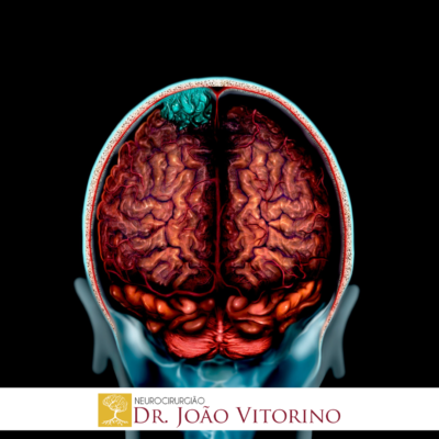 Meningiomas O Que Voc Precisa Saber Neurocirurgi O Em S O Paulo