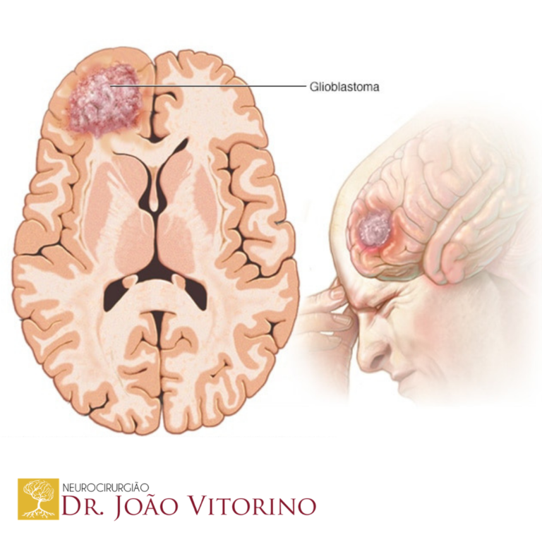 Sintomas Glioblastoma - Neurocirurgião em São Paulo - Especialista em ...