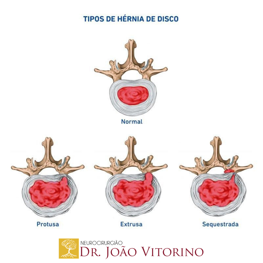 RM - Hérnia discal extrusa 