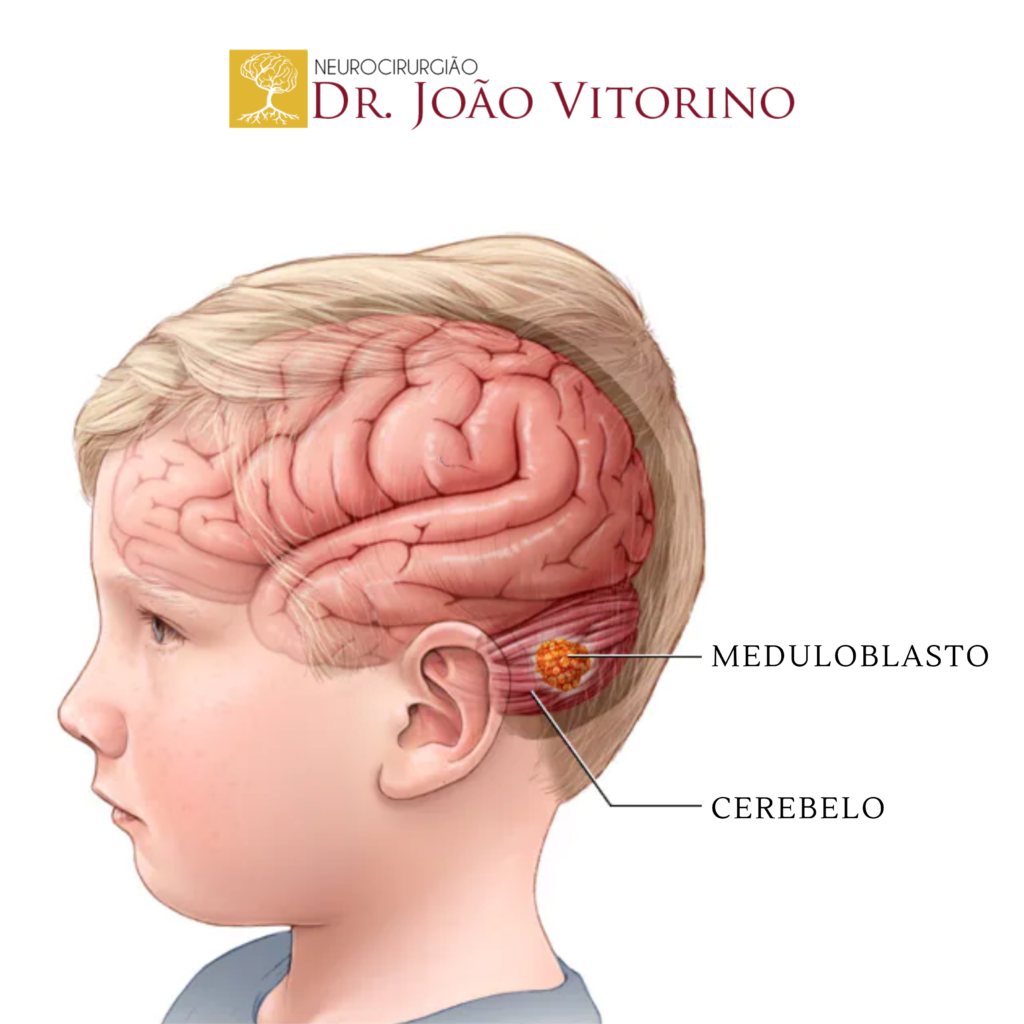 Медуллобластома головного мозга у детей. Медуллобластома червя мозжечка. Опухоль головного мозга на стволе мозжечка. Опухоль головного мозга у ребенка.