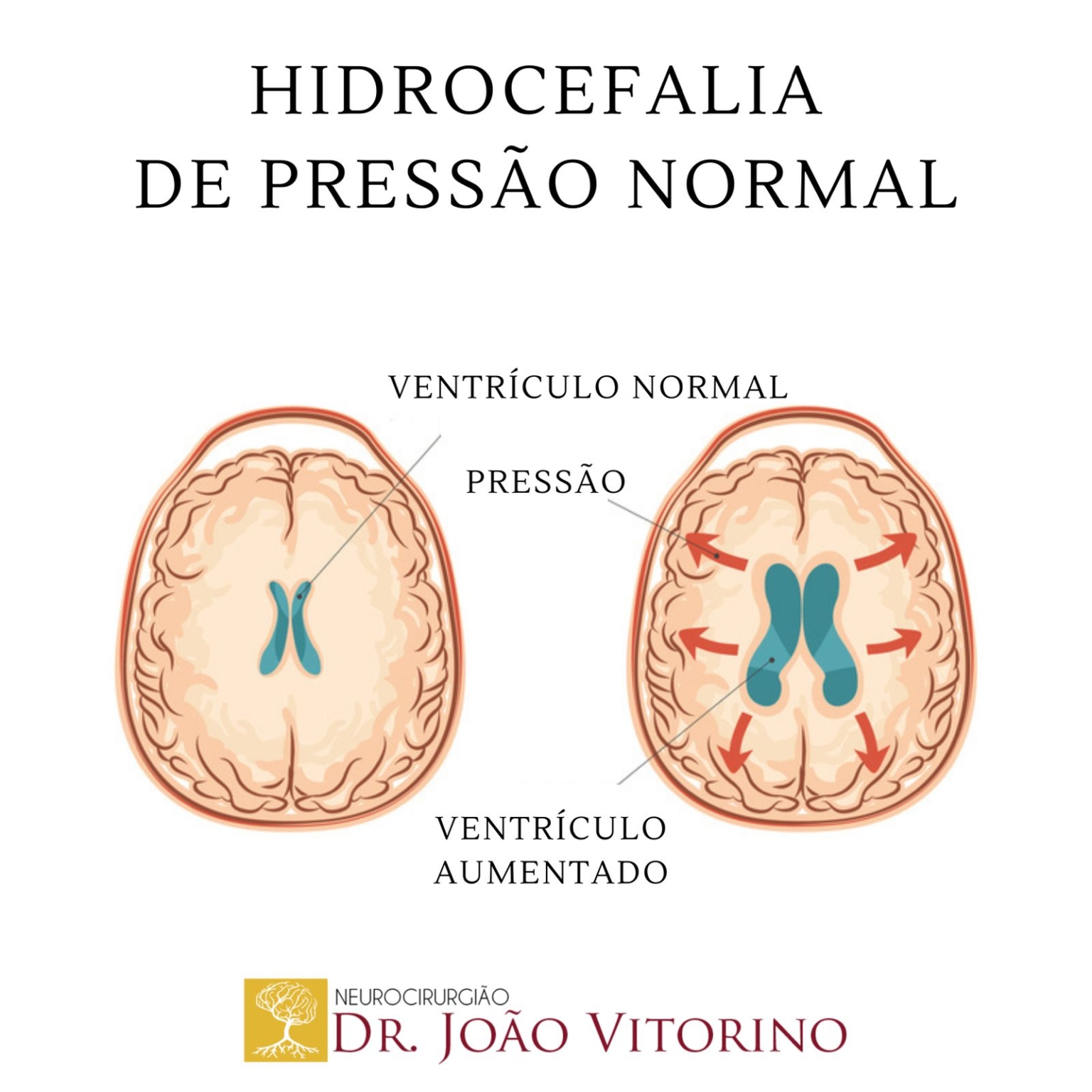 Hidrocefalia De Pressão Normal Neurocirurgião Em São Paulo Especialista Em Tumores Cerebrais 9248