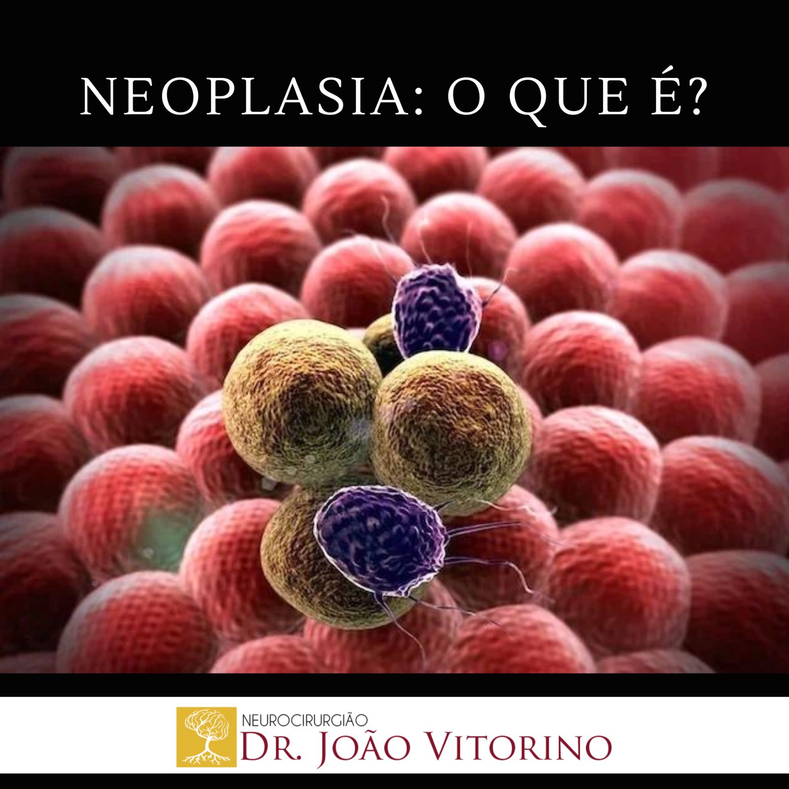 Neoplasia: o que é? - Neurocirurgião em São Paulo - Especialista em ...