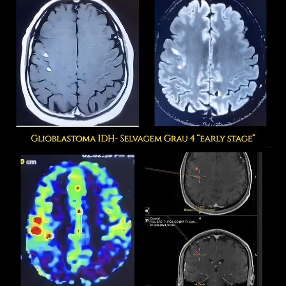 Glioblastoma IDH-Selvagem Grau 4 