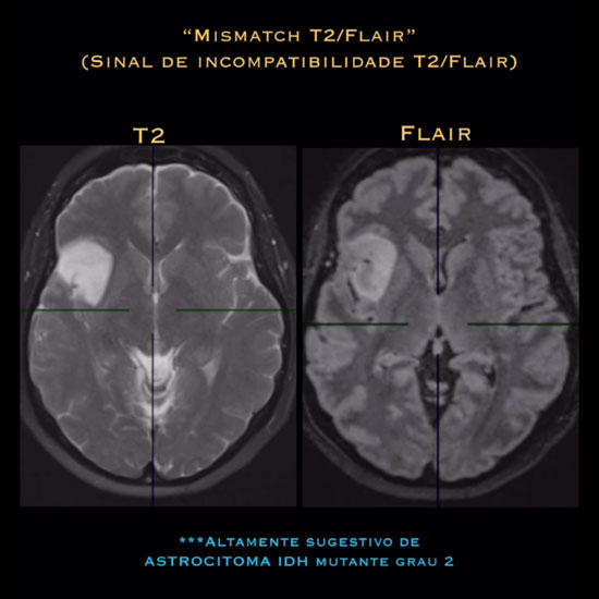 Glioma da Ínsula