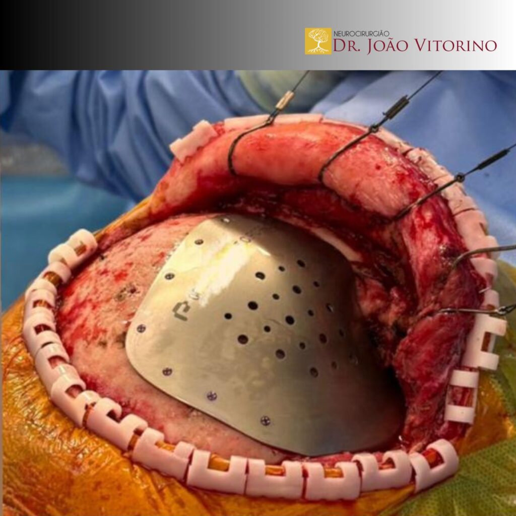 Cranioplastia: o que é, quando é indicada e como é realizada?